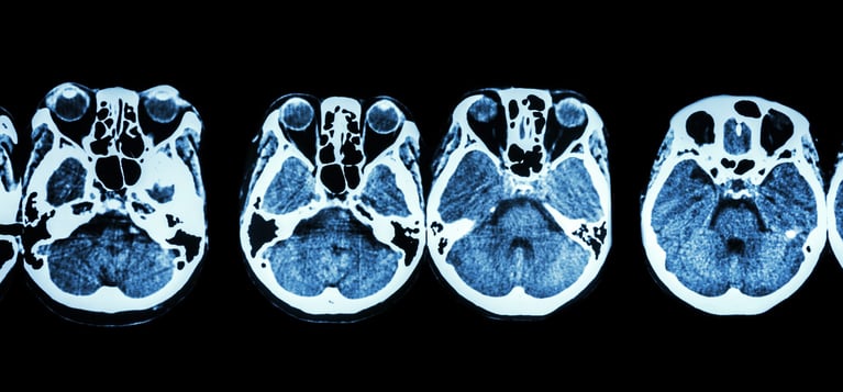 ct-scan-of-brain-1.jpg