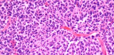 Kidney cancer_0.jpg