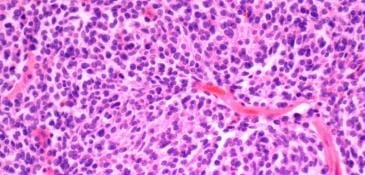 Kidney cancer_0.jpg