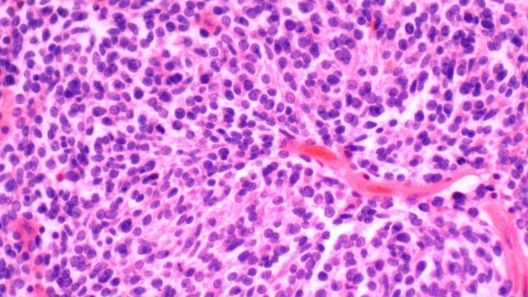 Kidney cancer 0