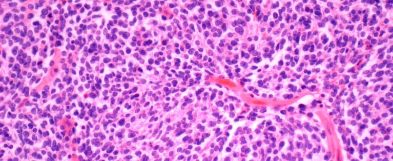 Kidney cancer.jpg