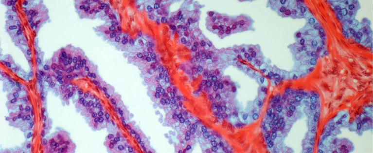 Prostate cancer_0_0.jpg