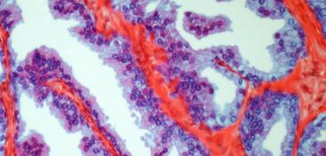 Prostate cancer