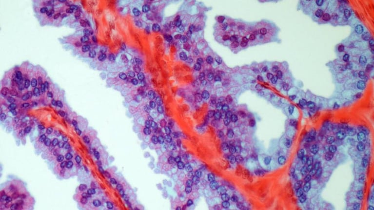 Prostate cancer (1).jpg