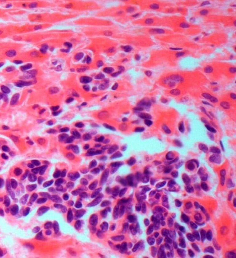 Secondary liver cancer_0_1.jpg