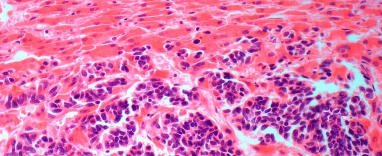 Secondary liver cancer_0_1.jpg