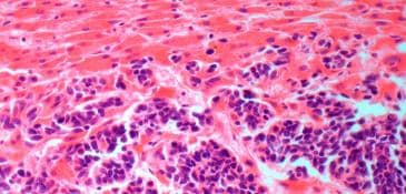 Secondary liver cancer