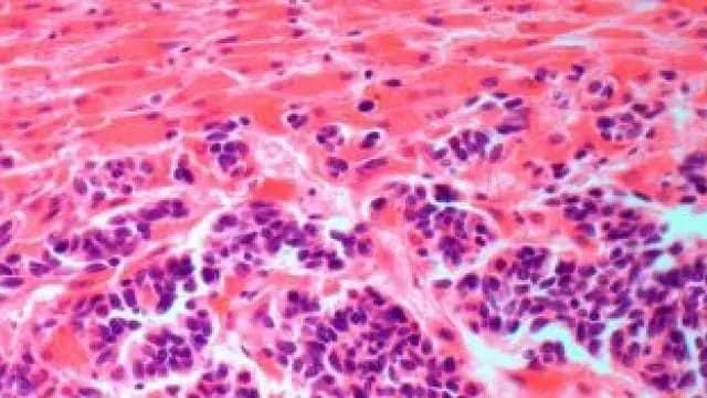 Secondary liver cancer.jpg