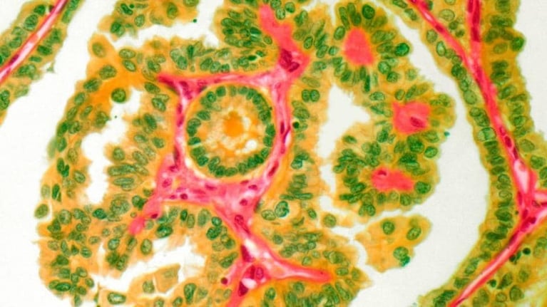 Thyroid cancer_0 (1).jpg