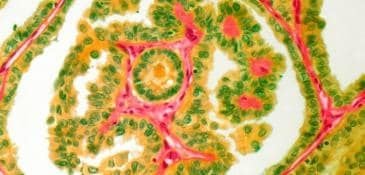 Thyroid cancer_0.jpg