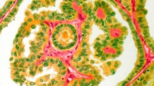 Thyroid cancer.jpg