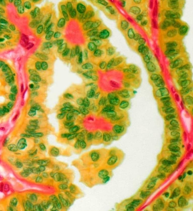 Thyroid cancer.jpg