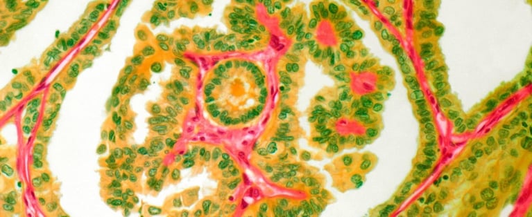 Thyroid cancer